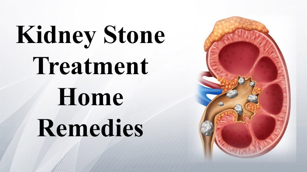 helps-removing-kidney-stone