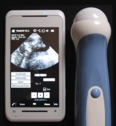 Mobius SP1 system/ultrasound