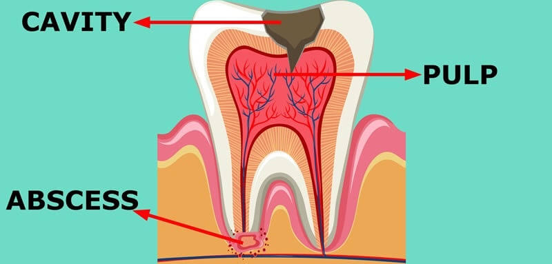 Abscess Tooth